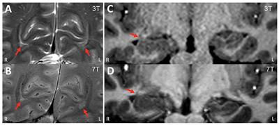 Radiological and Clinical Value of 7T MRI for Evaluating 3T-Visible Lesions in Pharmacoresistant Focal Epilepsies